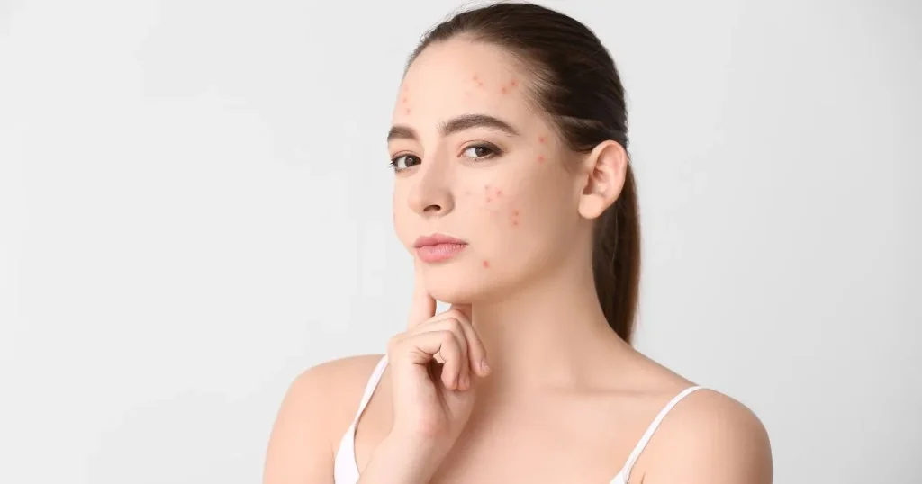 young woman with acne on her face-foods that cause acne